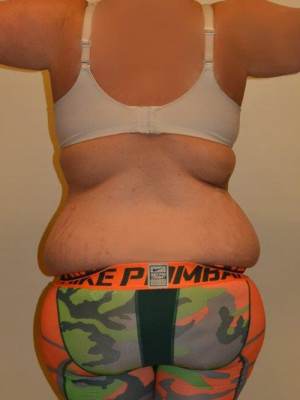 Liposuction Case 13431 Before Photo Liposuction