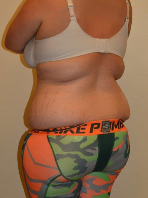 Liposuction Case 13431 Before Photo Liposuction