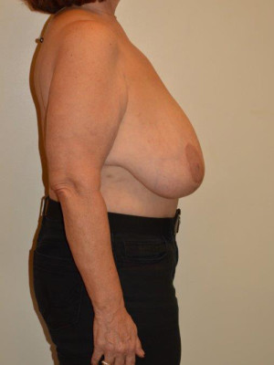 Breast Reduction Case 13432 Before Photo Breast Reduction