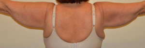 Arm Lift Case 13458 Before Photo Arm Lift