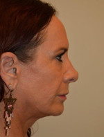 Facelift and Necklift