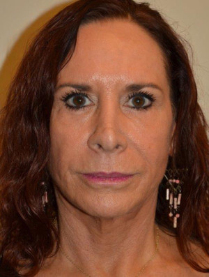 Facelift and Necklift Case 13468 After Photo Facelift and Necklift