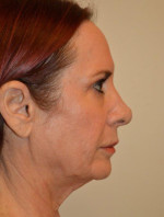 Facelift and Necklift