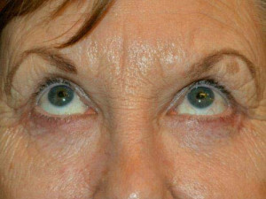 Eyelid Surgery Case 13476 After Photo Eyelid Surgery