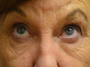 Eyelid Surgery