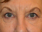 Eyelid Surgery