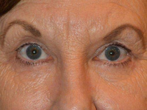 Eyelid Surgery Case 13476 After Photo Eyelid Surgery