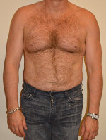 Male Pectoral Implants