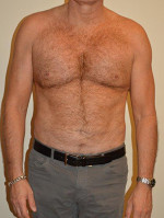 Male Pectoral Implants