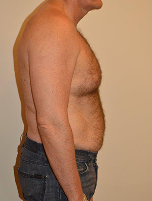 Male Pectoral Implants