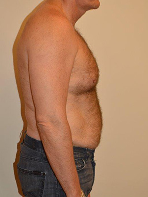 Male Pectoral Implants Case 13520 Before Photo Male Pectoral Implants