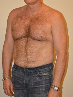 Male Pectoral Implants Case 13520 Before Photo Male Pectoral Implants