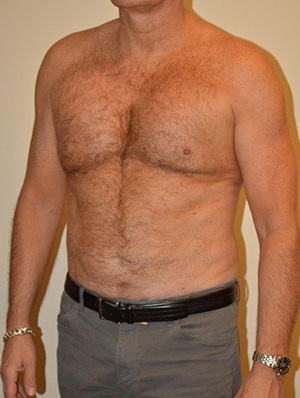 Male Pectoral Implants Case 13520 After Photo Male Pectoral Implants