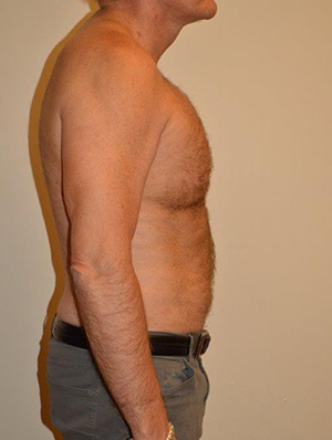 Male Pectoral Implants Case 13520 After Photo Male Pectoral Implants