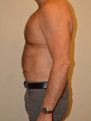 Liposuction Case 13528 After Photo Liposuction