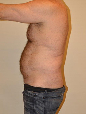 Liposuction Case 13528 Before Photo Liposuction