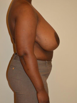 Breast Reduction Case 13534 Before Photo Breast Reduction