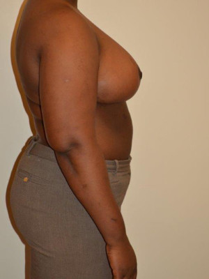 Breast Reduction Case 13534 After Photo Breast Reduction