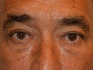 Eyelid Surgery Case 13569 Before Photo Eyelid Surgery