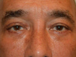 Eyelid Surgery