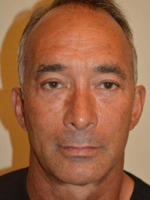 Nose Surgery Case 13573 After Photo Nose Surgery