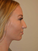 Nose Surgery