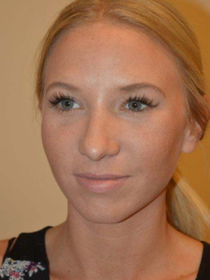 Nose Surgery Case 13598 After Photo Nose Surgery