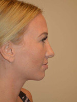 Nose Surgery