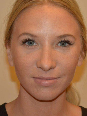 Nose Surgery Case 13598 After Photo Nose Surgery