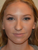 Nose Surgery