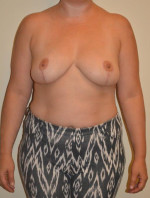 Breast Reduction
