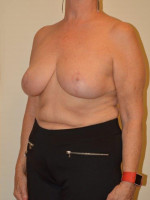 Breast Reduction