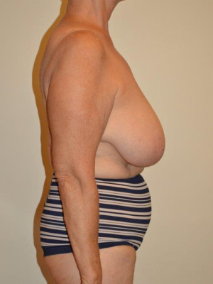 Breast Reduction Case 13600 Before Photo Breast Reduction