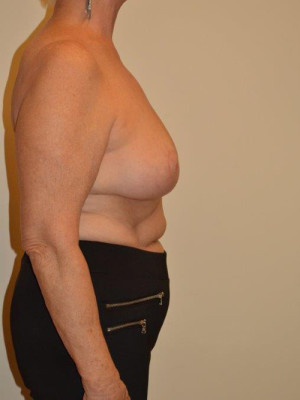Breast Reduction Case 13600 After Photo Breast Reduction