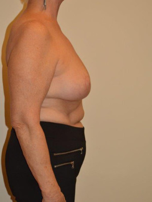 Breast Reduction