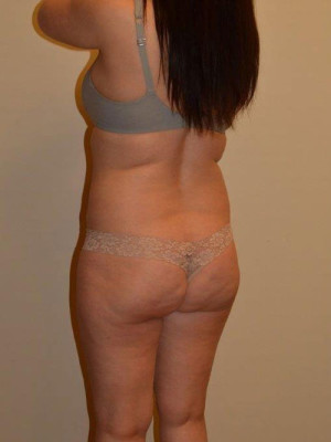 Buttock Lift Case 13701 Before Photo Buttock Lift