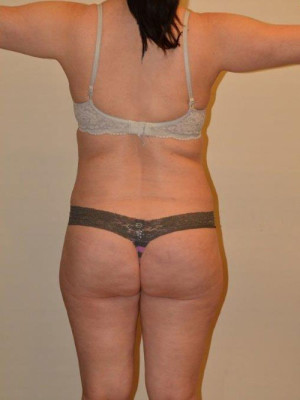 Liposuction Case 13696 After Photo Liposuction