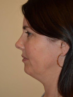 Neck Liposuction