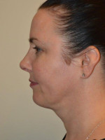 Neck Liposuction
