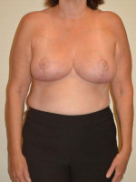 Breast Reduction