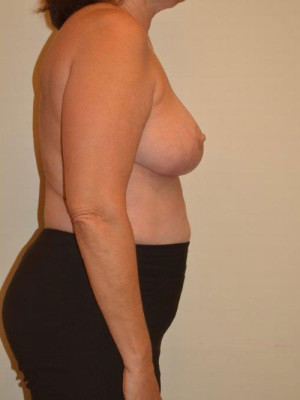 Breast Reduction Case 13660 After Photo Breast Reduction