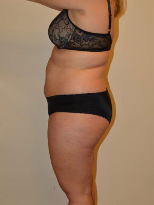 Liposuction Case 13667 Before Photo Liposuction