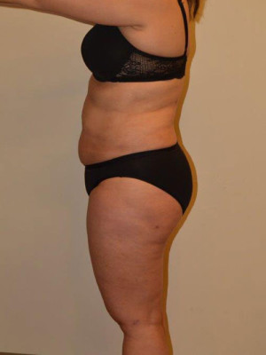 Liposuction Case 13667 After Photo Liposuction