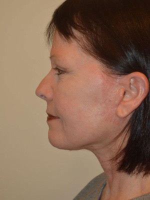 Facelift and Necklift Case 13664 After Photo Facelift and Necklift