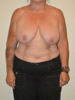 Breast Reduction