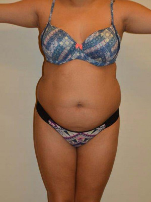 Liposuction Case 13778 Before Photo Liposuction