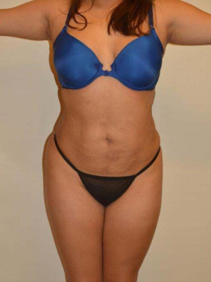 Liposuction Case 13778 After Photo Liposuction