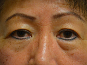 Eyelid Surgery Case 13853 Before Photo Eyelid Surgery