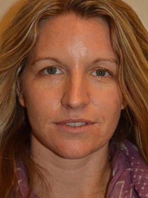 Nose Surgery Case 13840 Before Photo Nose Surgery