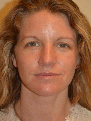 Nose Surgery Case 13840 After Photo Nose Surgery